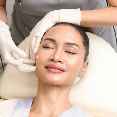 Endolift®