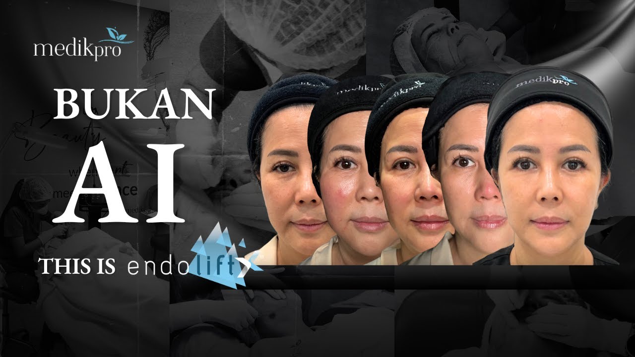 BUKAN AI : Ini Dia EndoliftX®️ yang Efektif untuk Double Chin dan Leher Berlemak pada Usia 50++